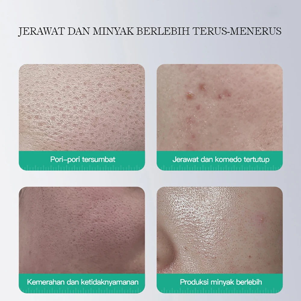 Nettoyant exfoliant pour le visage à l'acide salicylique